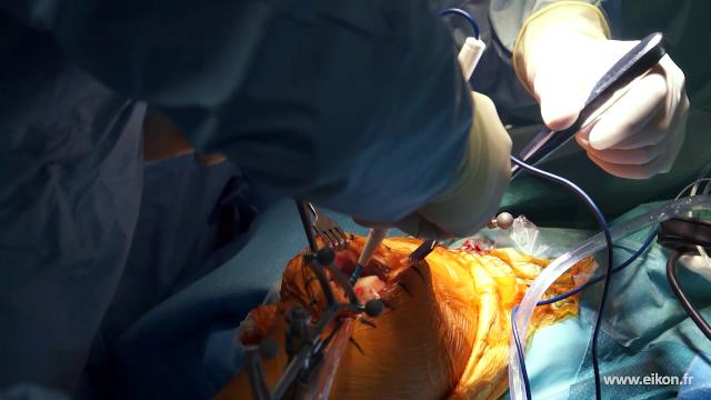 Vidéo chirurgie PUC avec l'assistance robotique